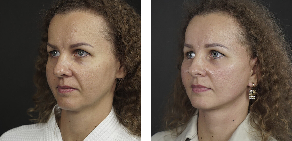 До и спустя 3 недели после круговой подтяжки лица и эндоскопической подтяжки лба. 