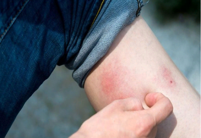 Укусы у нее - аллергичные, чешутся долго.