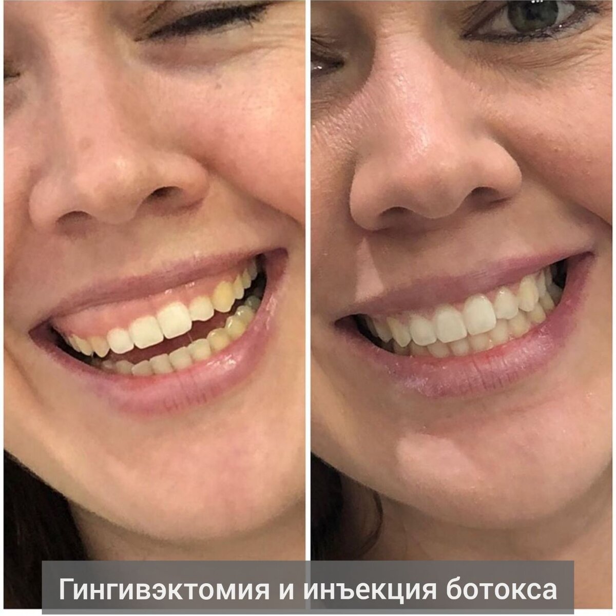 Коррекция улыбки ботоксом фото до и после