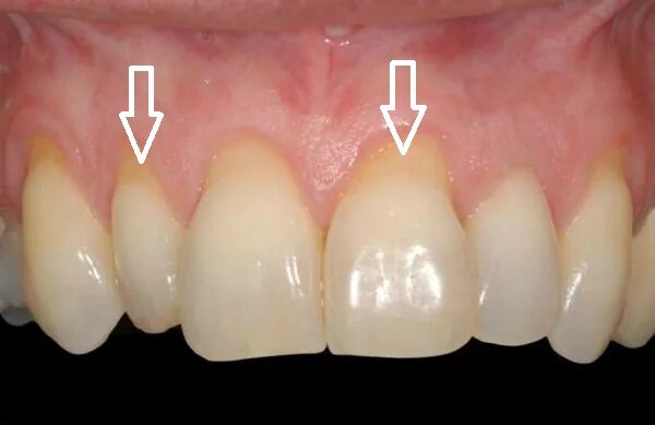 Дисплазия эмали зубов: признаки патологии и способы лечения