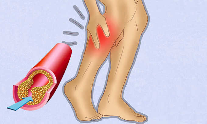 Экспертная оценка Боль в ноге может возникать из-за проблем с артериями и/или венами в нижних конечностях. Кровеносные сосуды в ноге могут закупориваться, сдавливаться или воспаляться.-2