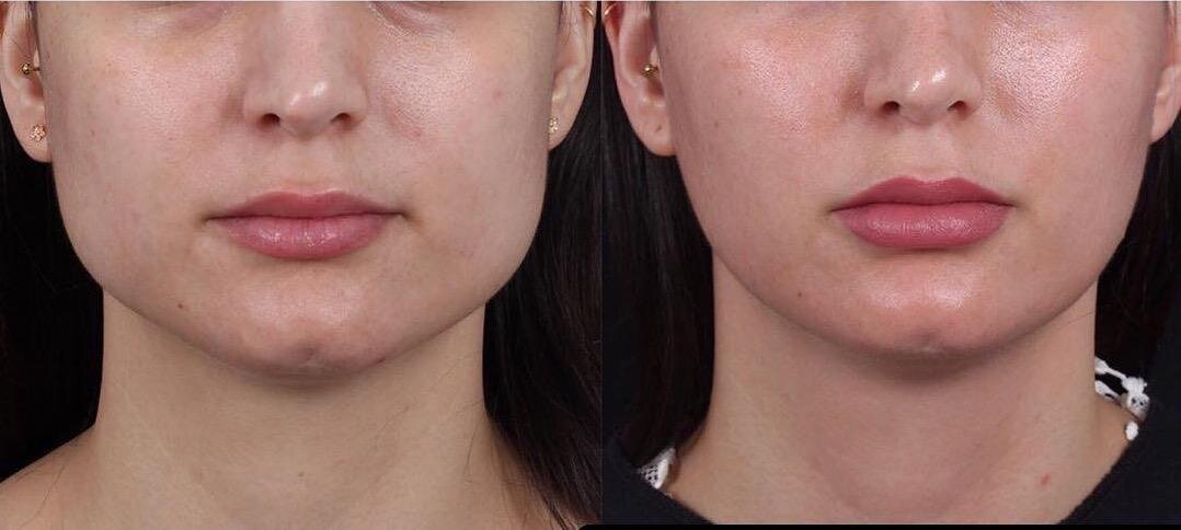 До и после инъекций ботулотоксина