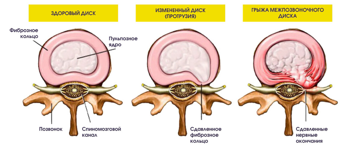 Протрузия может предшествовать грыже межпозвонкового диска.