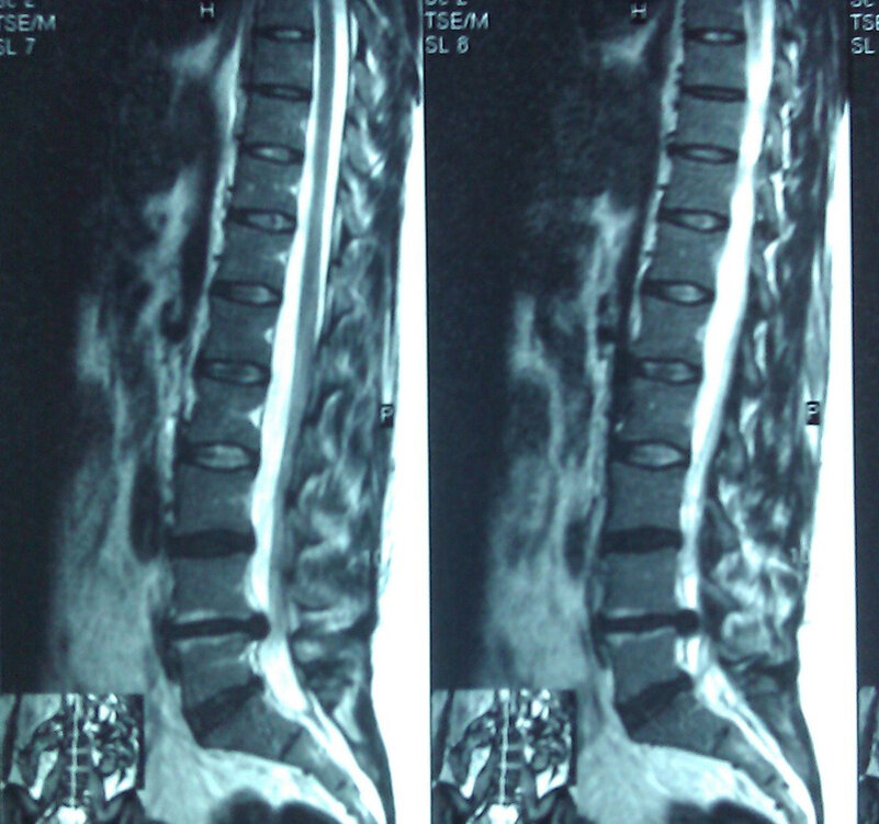 Грыжа межпозвонкового диска в поясничном отделе позвоночника.