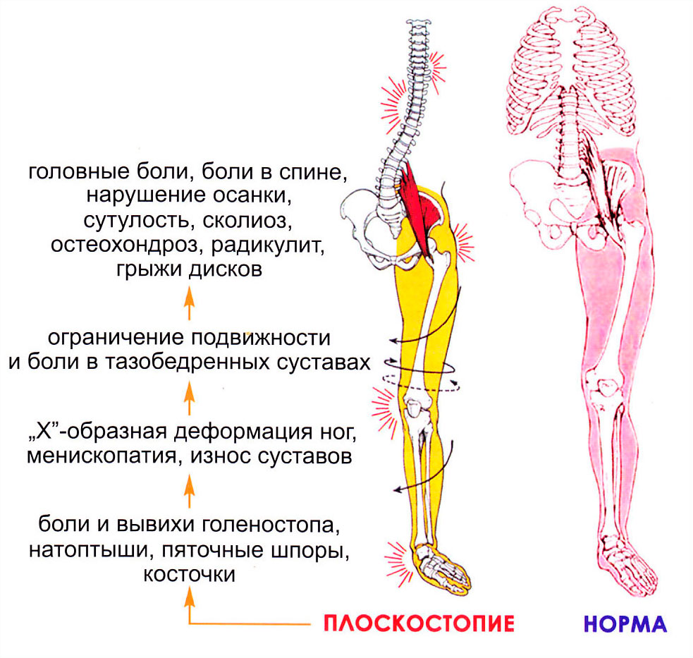 Плоскостопие влияет на походку или походка влияет на плоскостопие? | Сам  Себе Ортопед. Спб. | Дзен