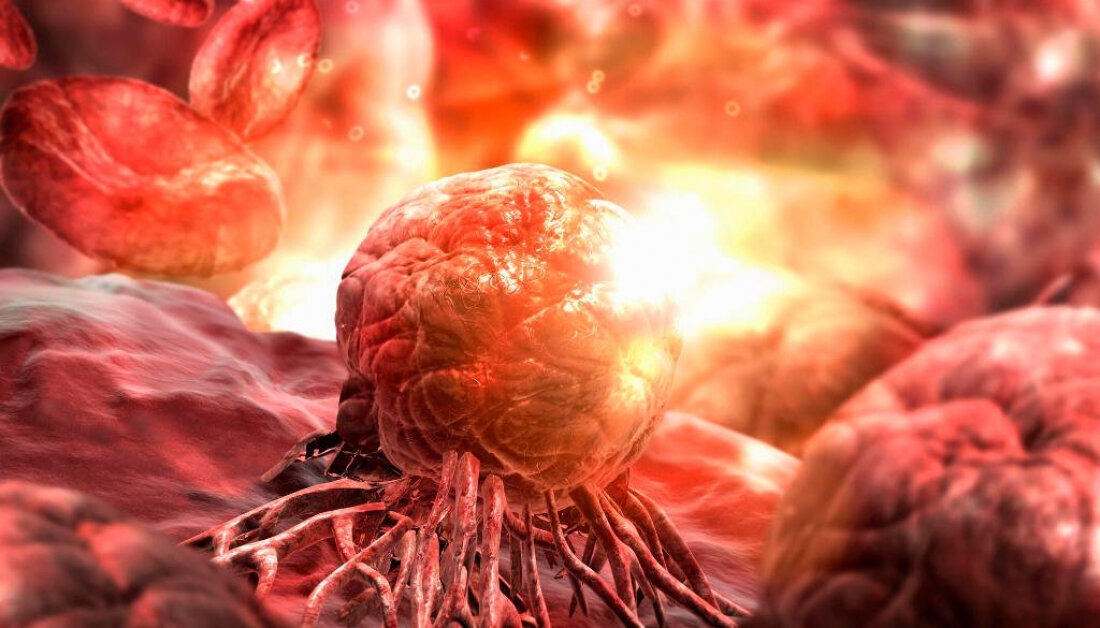 опухолевые клетки. злокачественные новообразования. онкологические заболевания презентация. как онкология назывались по другому. злокачественные новообразования.