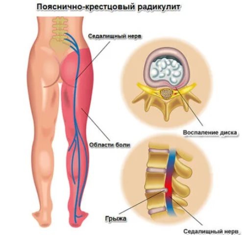 Одной из распространенных причин болевых ощущений в пояснице является радикулит. Это болезнь, вызванная поражением корешков спинного мозга. Часто многие из тех, кто страдает от болевых ощущений, списывают боль именно на радикулит. 