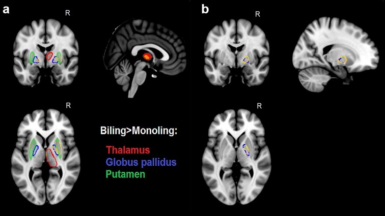 Влияние погружения в языковую среду на подкорковые структуры. a. Показывает значительные различия между билингвами и монолингвами: увеличение с двух сторон в бледном (синий), двустороннем путамене (зелёный) и правом таламусе (красный). b. Показывает части правого бледного шара, на которые оказало влияние погружение в языковую среду. (Credit: Pliatsikas C., DeLuca V., Moschopoulou E. & Saddy J. D. (2017). Immersive bilingualism reshapes the core of the brain. Brain Structure and Function, 222(4), 1785–1795. https://doi.org/10.1007/s00429-016-1307-9 under Creative Commons Attribution 4.0 International License) 