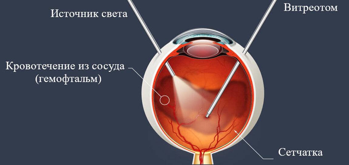 Схема операции на сетчатке (Яндекс картинки)
