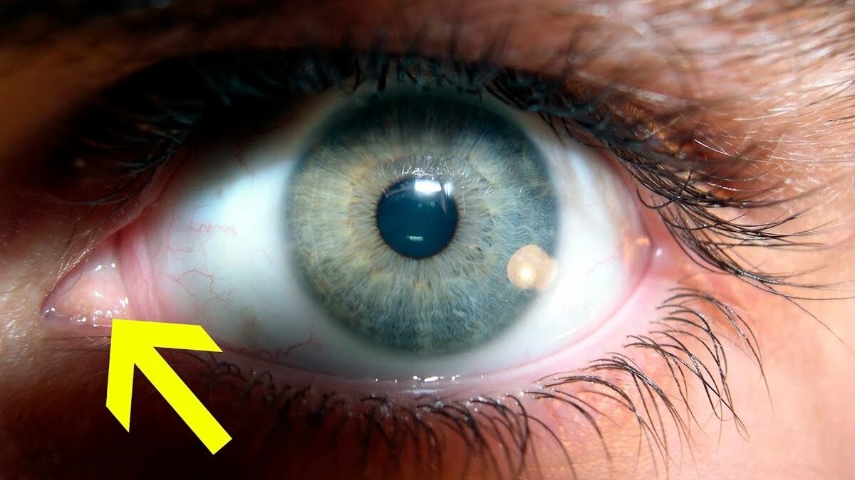 Третье веко у человека.