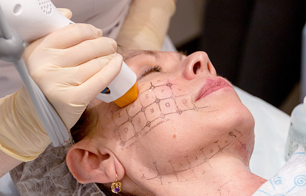 Thermage CPT (Solta Medical Inc., США)