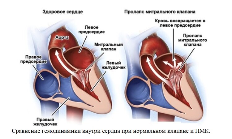 Недостаточность предсердия. Пролапс нейтрального клапана сердца 1 степени. Пролаз передней створки митрального клапана. Пролабирование створок митрального клапана 1. Диагноз:i34.1 пролапс пролабирование митрального клапана.