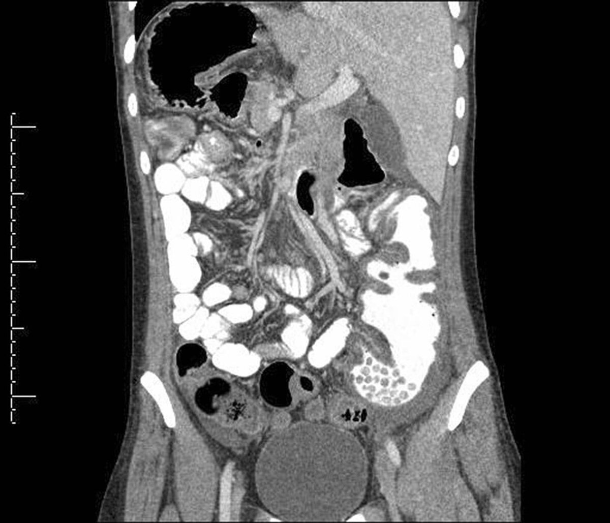 Мрт органов брюшной. Компьютерная томография (кт) брюшной полости. Томограмма брюшной полости кт. РКТ брюшной полости. Снимки кт брюшной полости с контрастом.