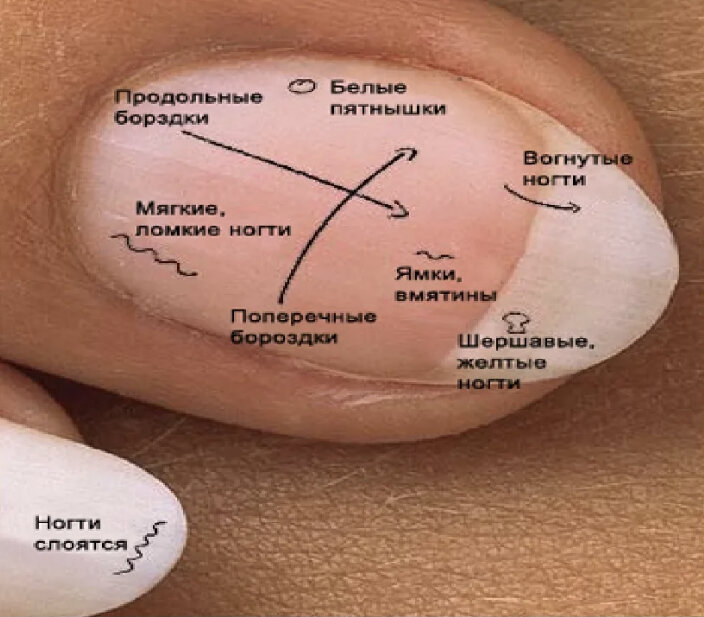 Как по ногтям определить заболевание организма фото человека