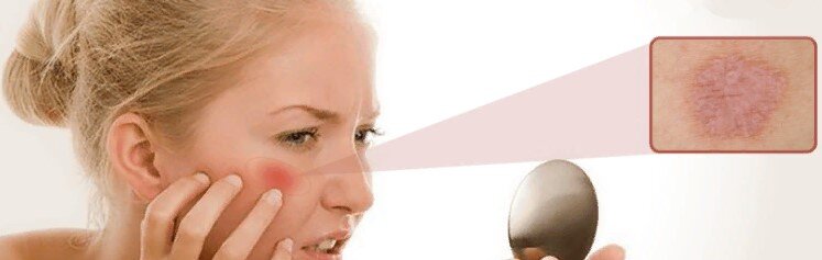Разновидности и лечение болезни Жибера (Розовый лишай)