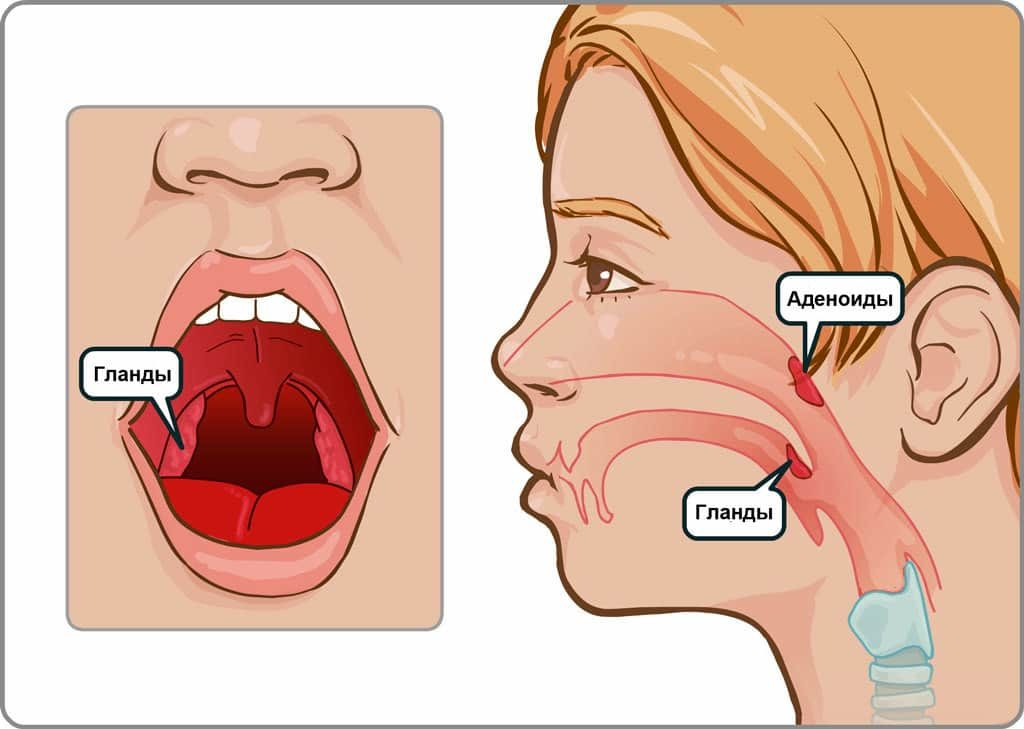 Что такое аденоиды и как их лечить?