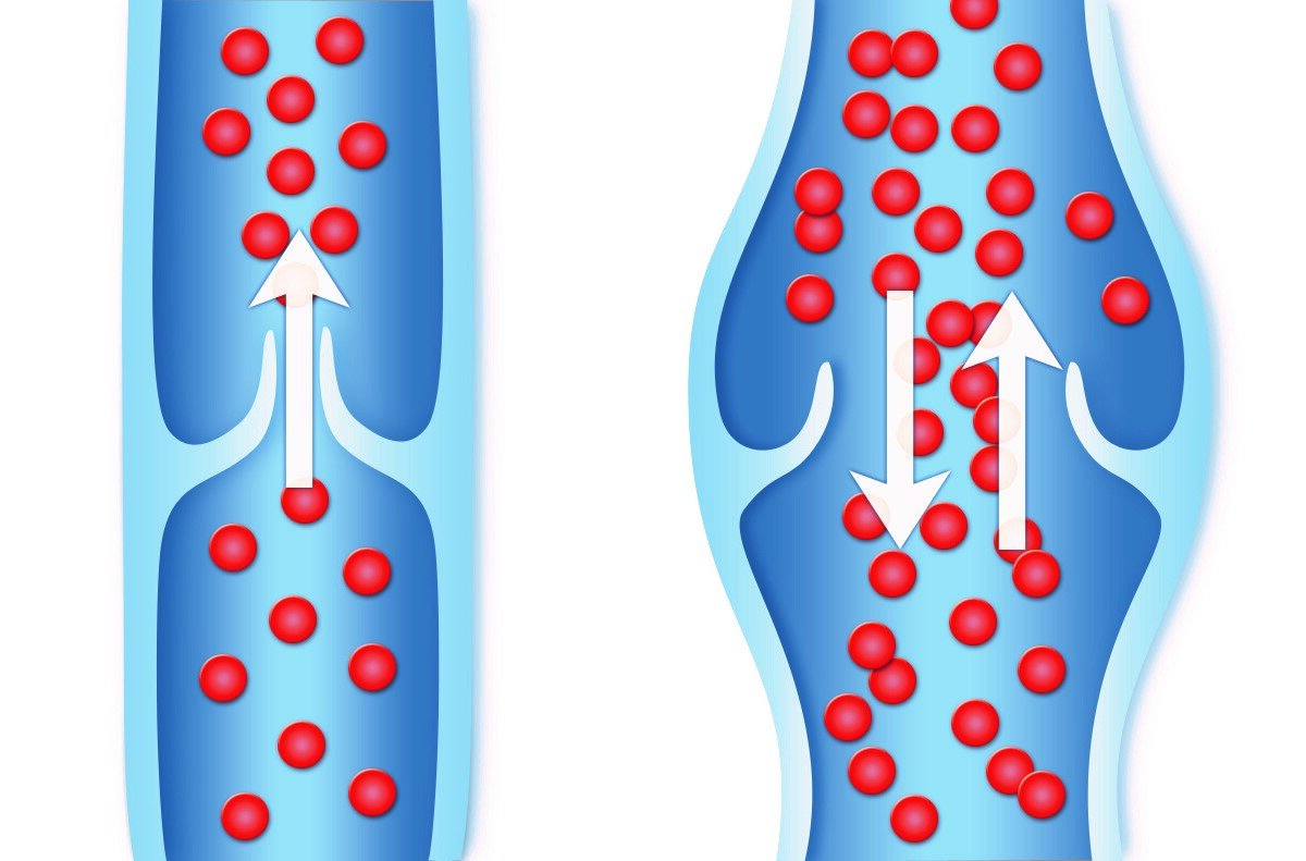 Клапаны вен рисунок. Венозные клапаны варикоз. Клапаны в венах нижних конечностей.