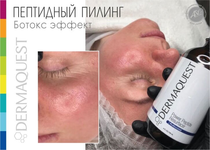 Результат после 1 процедуры: улучшение рельефа кожи, разглаживание мелких морщин и морщин сухости, Лифтинг и уплотнение кожи, Устранение гиперкератоза - гладкость кожи 