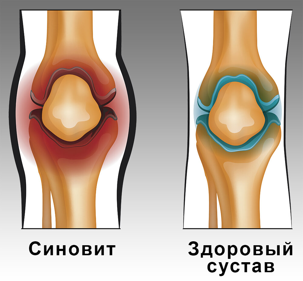 Выраженный синовит