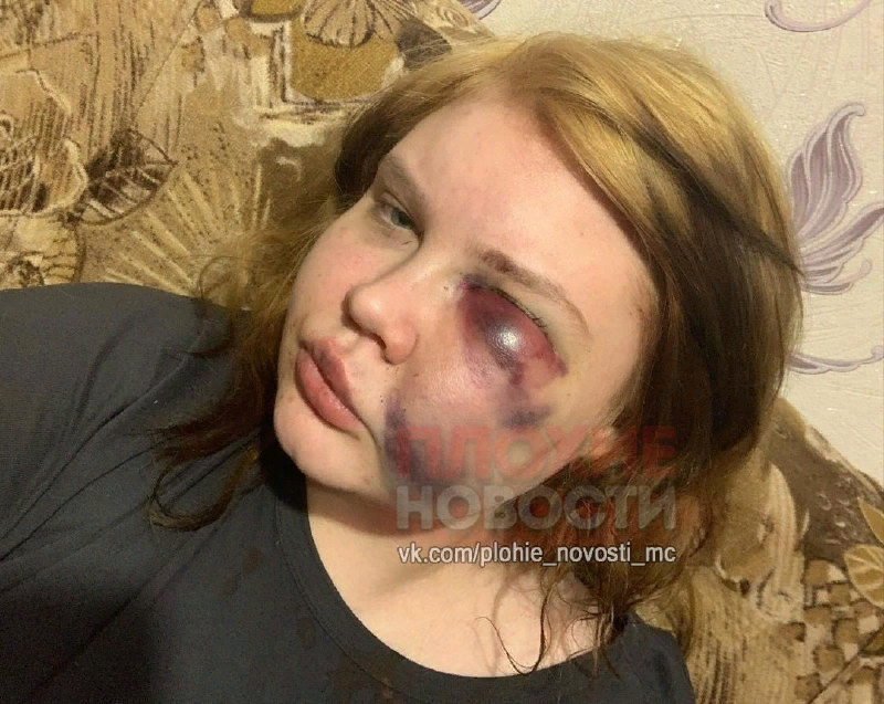 Анна после драки