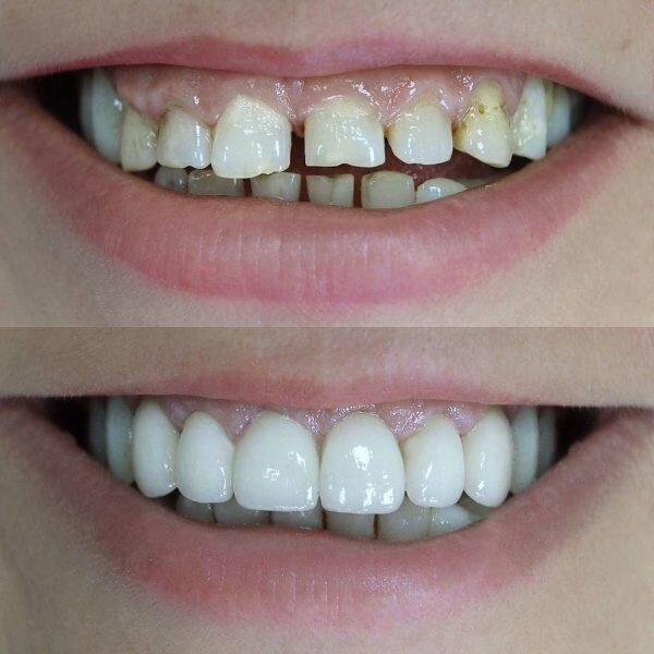 Кривые зубы, фото до и после, виниры, брекеты - 22 сентября - вторсырье-м.рф