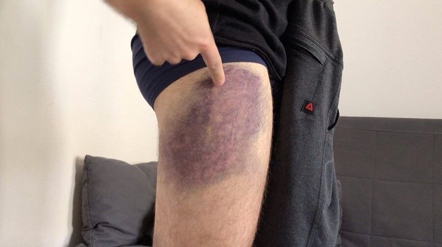 Зафиксированные повреждения на теле