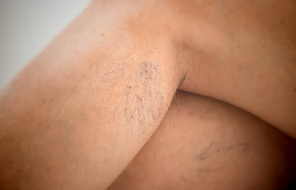 Варикозное расширение вен