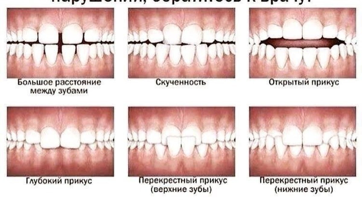 Виды неправильного прикуса