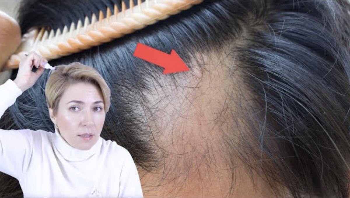 Восстановление выпавших волос. Отросшие волосы после выпадения.
