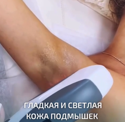 Процедура лазерной эпиляции в студии "FORMA"