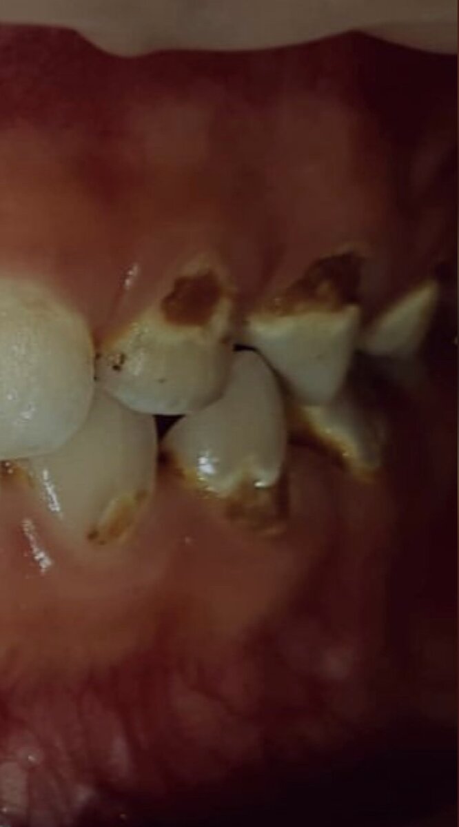  Почему зубы стали чёрные? Что это? ⠀ Если вы видите у ребёнка чёрные зубы, то это могут быть 3 варианта причин: ⠀ ✔зубы с кариесом  ✔зубы посеребрили  ✔на зубах чёрный налёт.