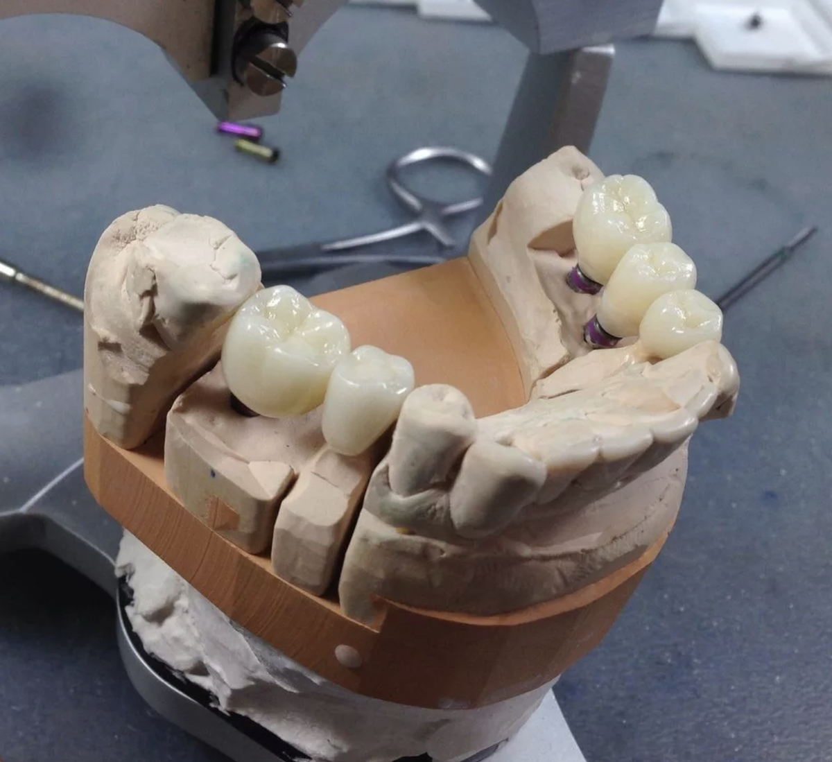 Стоматологические коронки. Зуб с короной. Коронка металлокерамика.