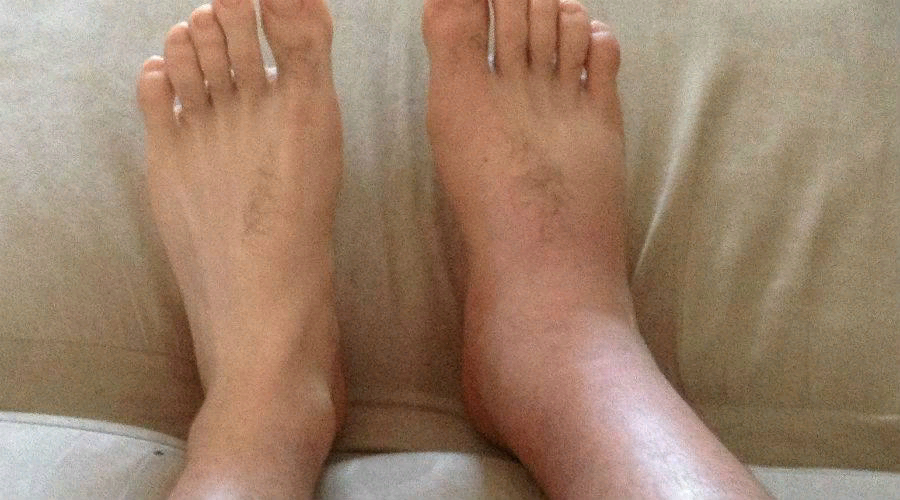 Отеки и усталость ног.