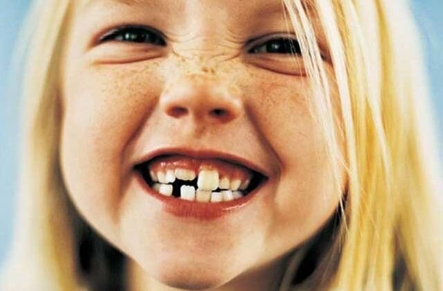 Редкие Зубы - Как Исправить У Детей И Взрослых