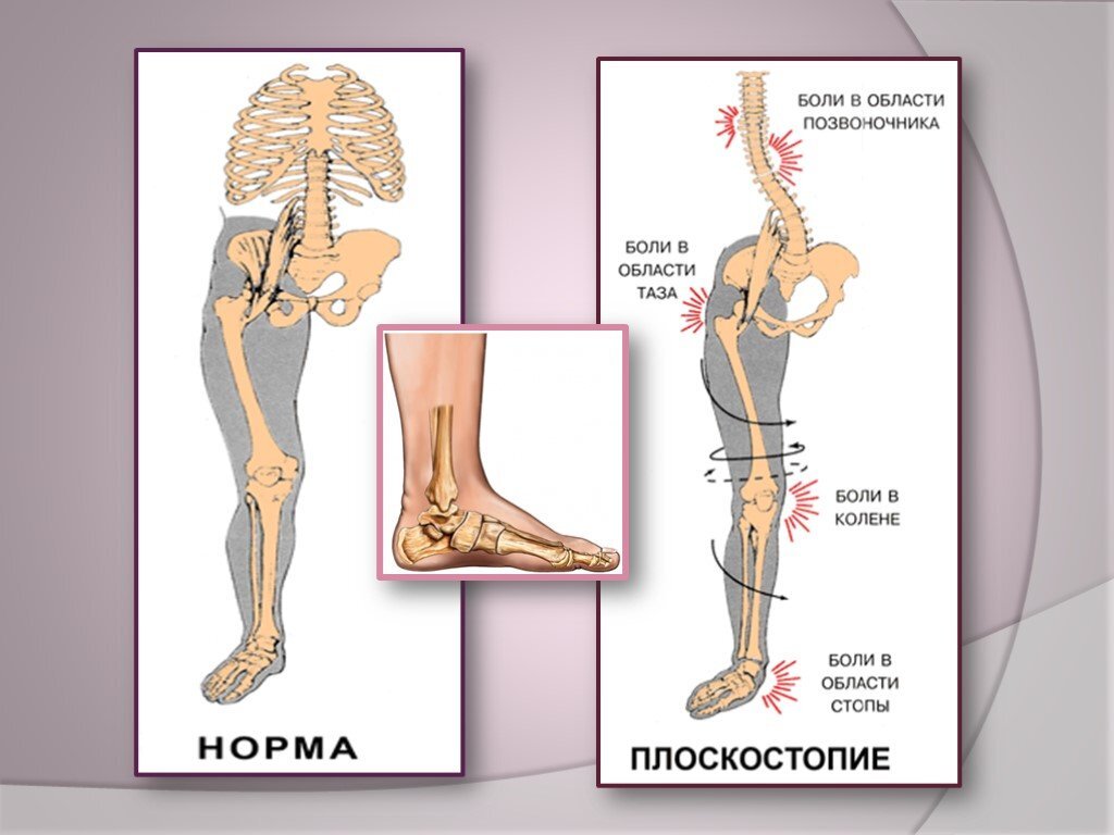 Коррекция стоп. | Блог ортопеда Оханцева Фёдора | Дзен