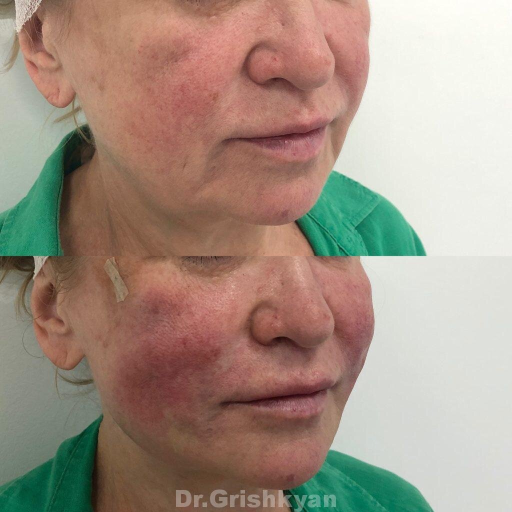 Пример подтяжки нитями до и после. Фото с сайта Д.Р. Гришкяна. Имеются противопоказания, требуется консультация специалиста