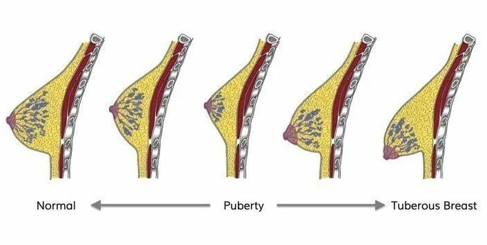 Тубулярная форма молочных желез