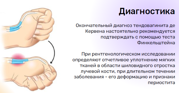 Де кервена код по мкб 10. Болезнь де Кервена кисти. Тендовагинит де Кервена. Теносиновит де Кервена. Болезнь де Кервена лучезапястного сустава.