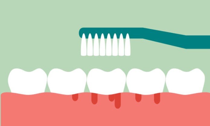 Кровоточивость дёсен