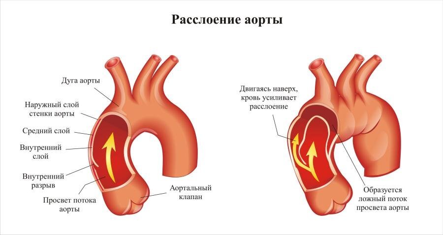 Аорта — самый большой по диаметру сосуд, который отходит от сердца. От аорты отходят артерии к сердцу (коронарные) к головному мозгу (брахиоцефальные) к верхней половине тела (подключичные).-2