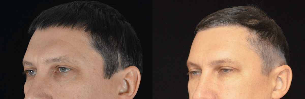 Блефаропластика нижних век. Фото с сайта Д.Р. Гришкяна. Имеются противопоказания, требуется консультация специалистов