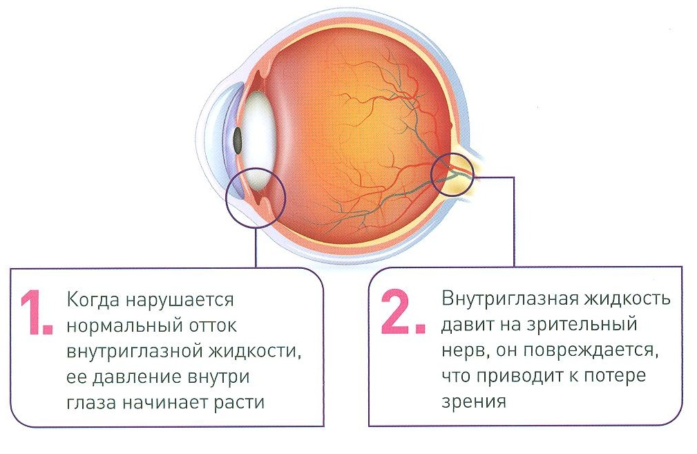 Может ли внутриглазное давление. Какая часть глаза поддерживает внутриглазное давление. Повышение внутриглазного давления (глаукома).. Заболевание, при котором повышается внутриглазное давление.