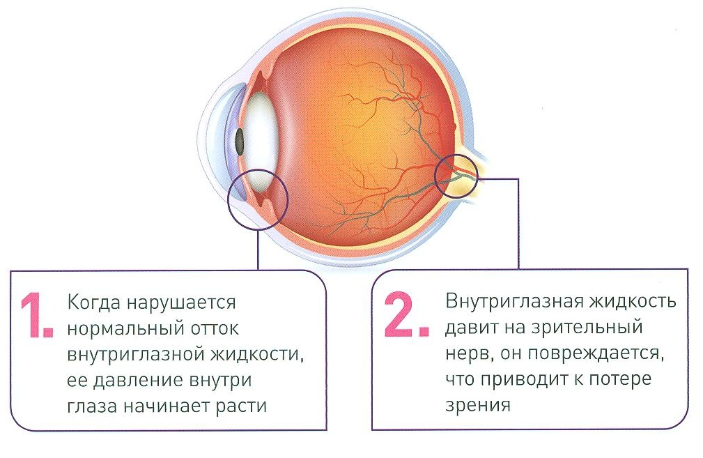 Строение глаза глаукома. Какая часть глаза поддерживает внутриглазное давление. Глаукома внутриглазное давление жидкость. Повышение внутриглазного давления.