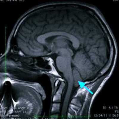 Аномалия арнольда киари код. Мальформация киари 1 типа. Мальформация арнольда-киари 2 типа. Аномалия арнольда киари код. Аномалия арнольда-киари 1 степени у детей.