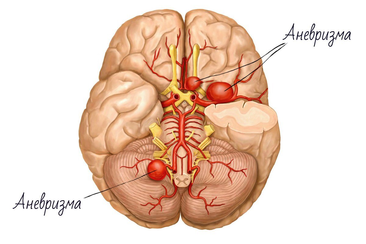 МРТ ДИАГНОСТИКА АНЕВРИЗМЫ ГОЛОВНОГО МОЗГА | Все о КТ и МРТ | Дзен