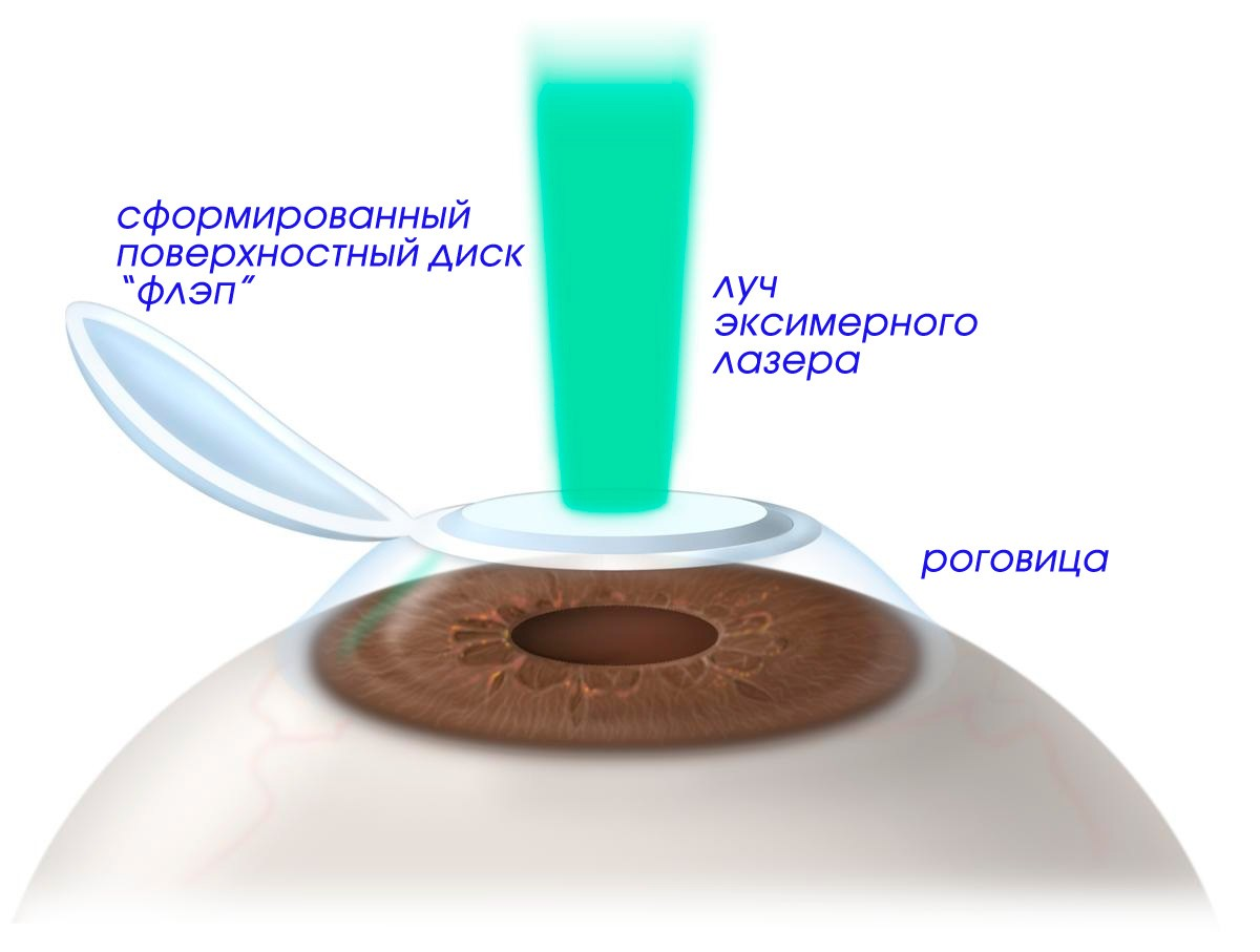Фемто ласик операция на глаза. Лазерная коррекция зрения методом ФРК. Эксимер-лазерная коррекция астигматизма. Методика ласик коррекция.