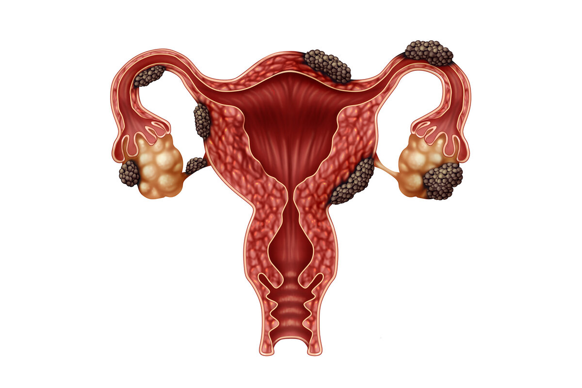 Эндометриоз: откуда он берётся, как проявляется и основные методы лечения |  Записки гинеколога | Дзен