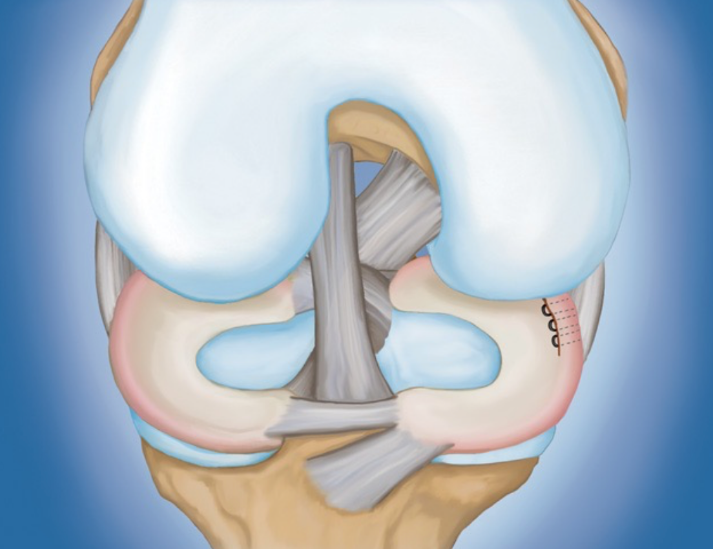 Разрывы менисков занимают более 70% всех травм коленного сустава