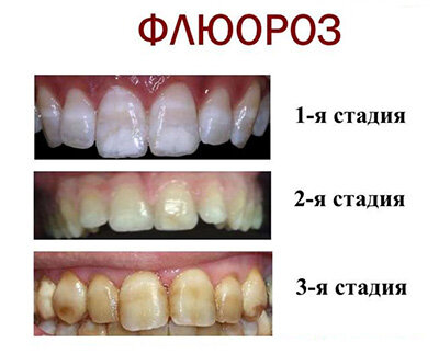 Стадии флюороза