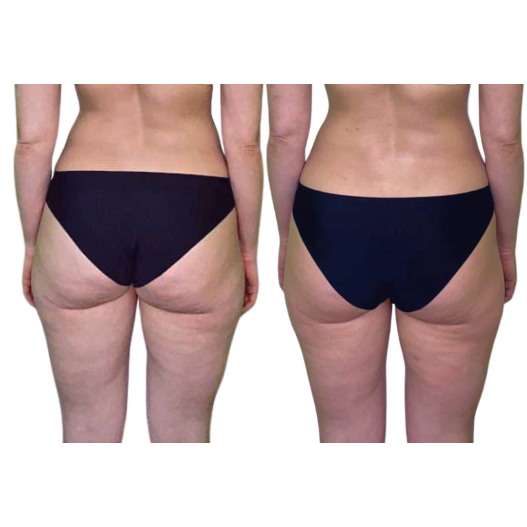 Процедуры на аппарате Налар